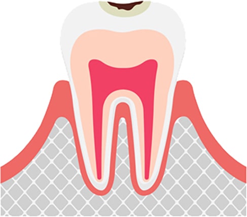 C1（エナメル質の虫歯）