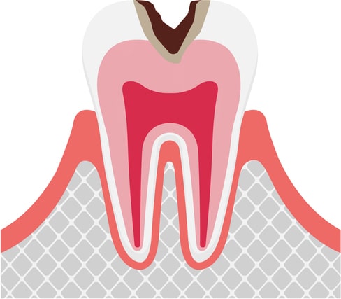 C2（象牙質の虫歯）